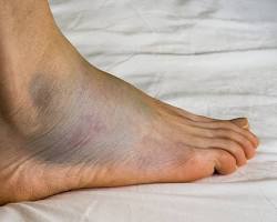 Swollen ankles and feet due to injuries
