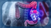 Health Canada Approves Nivolumab Plus Ipilimumab for Unresectable MSI-H/dMMR CRC and Unresectable HCC