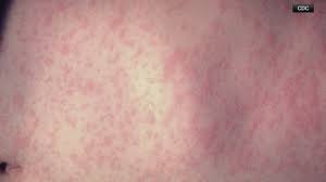 Measles Outbreak Linked to Turkish Airlines Flight: What You Need to Know