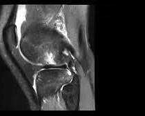 MRI scan showing ACL tearの画像