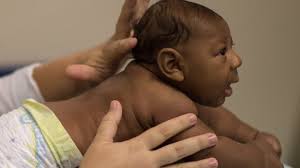 Image result for pictures of zika babies