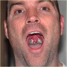 Image result for tonsil stones