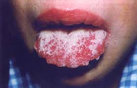 Znalezione obrazy dla zapytania candida na języku