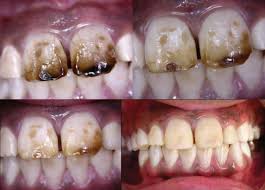 Image result for fluorosis