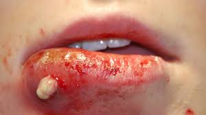 Image result for mrsa