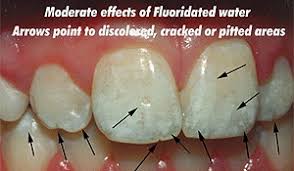 Image result for fluorosis
