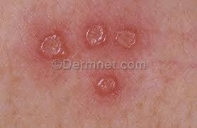 Image result for "Herpes Zoster"