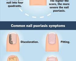 Psoriasis nails