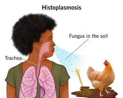 Image of Histoplasmosis