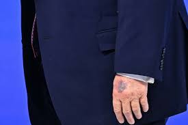 Concerns Rise Over President Trump's Health Following Discoloration of Hands