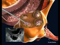 Punción ovárica