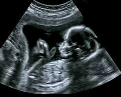 Image of Ultrasound of a baby in the womb