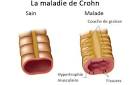 Maladie de crohn