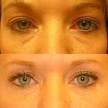 Puffy Eyes - Causes Remedies for Swollen Puffy Eyes