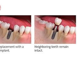 Dental implant tooth extraction