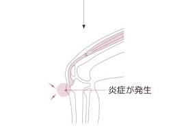 オスグッドの原因となる動作の画像