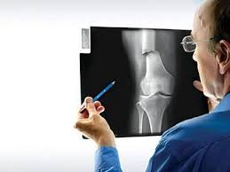 nguyen-nhan-benh-xuong-khop