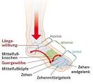 Plattfuss - Fussfehlstellungen Knicksenkfuss, Spreizfuss, Plattfuss