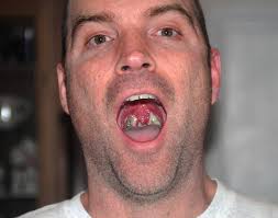 Image result for tonsilith