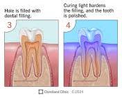 Image of Cavity Filling