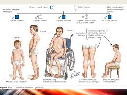 Image result for Duchenne muscular dystrophy