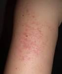 Keratosis pilaris - NHS Choices