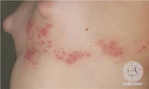 Image result for "Herpes Zoster"