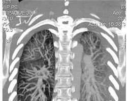 Image of Lungs with EVALI