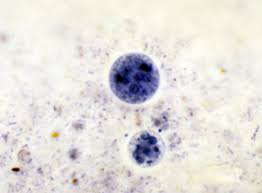 Znalezione obrazy dla zapytania Cysta