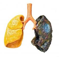 Resultat d'imatges de tumor y cancer de pulmon