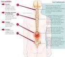 Point de douleur dans le dos