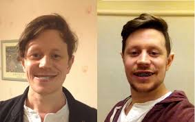 Image result for jaw surgery