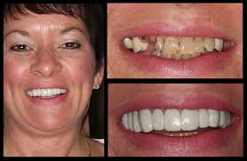 Before &amp; Afters - snap-on-smile
