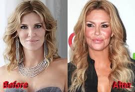 Resultado de imagem para before after surgery
