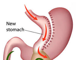 Mini Gastric Bypass surgery