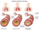 Bronchitis oder asthma