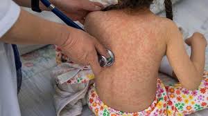 Ampliarán vacunación contra el sarampión ante repunte de contagios -