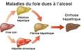 Cirrhose du foie - Symptmes - Sant-Mdecine