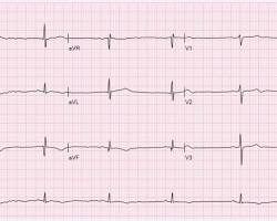 Image of Bradicardie EKG