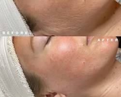 Image of skin before and after dermaplaning