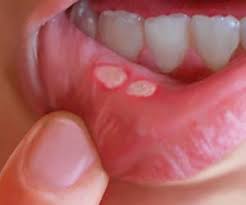 antiseptik yara spreyi ile ilgili görsel sonucu