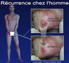 Traitement herpes femme