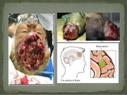 Hasil gambar untuk Menyebabkan Kanker Otak