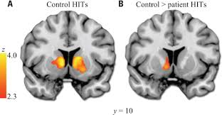 Image result for ventral striatum