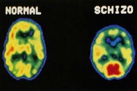 Can You Inherit Schizophrenia?