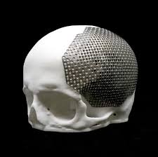 Anatomics - AnatomicsTitanium™ Cranial Implant Manufactured ...