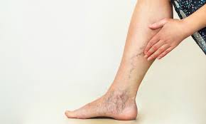 Dealing with Swollen and Red Legs – Insights from Dr. Ellie Cannon, GP