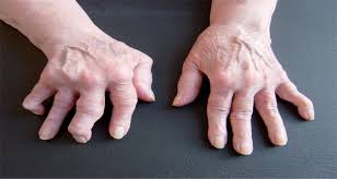 Image result for What is an Acute Articular Rheumatism?