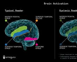 Imagem de Neuroimaging and Dyslexia