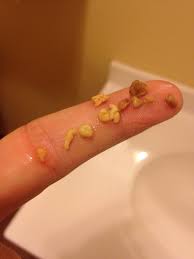 Image result for tonsil stones